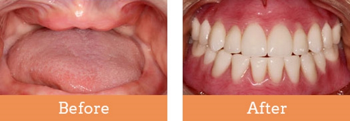 dentures before immediate services gum natural